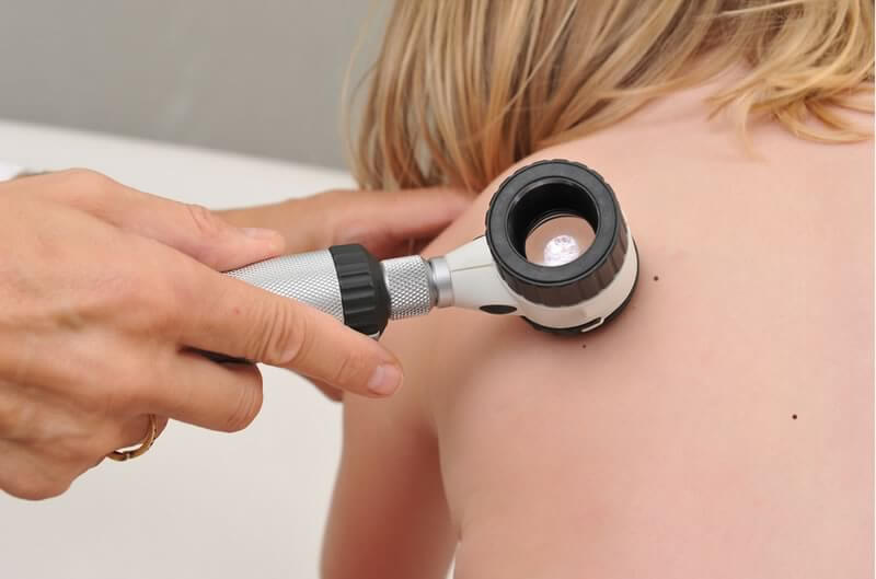 Cand este necesara dermatoscopia?