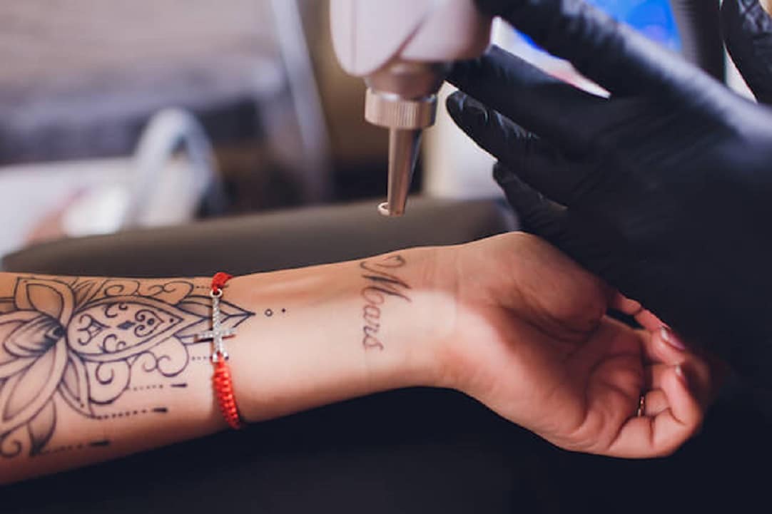 Care sunt consecintele indepartarii unui tatuaj cu un laser?