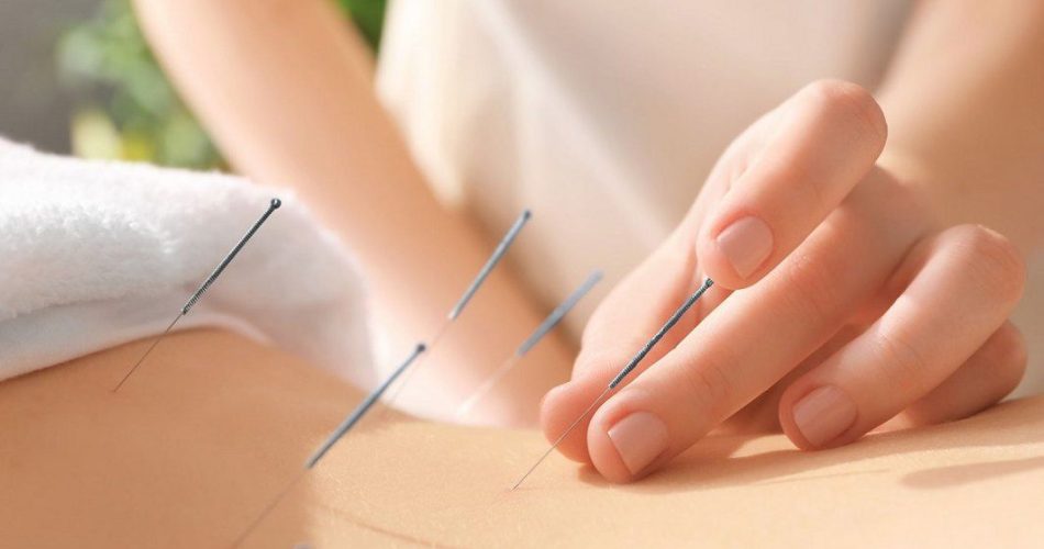 Pentru ce este acupunctura?